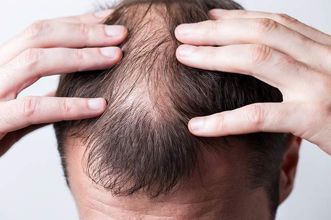 Hair Loss in Men: Common Causes and Effective Solutions
