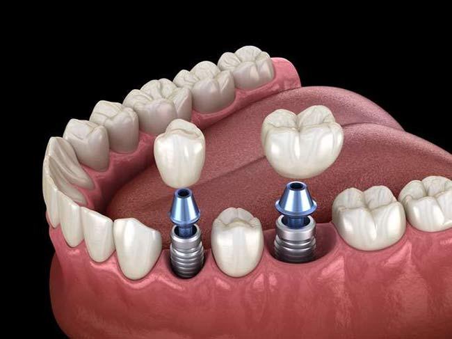 Exploring the Benefits of All-on-4 Dentures Implants